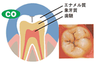 虫歯C0