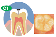 虫歯C1