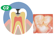 虫歯C2