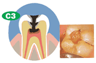 虫歯C3