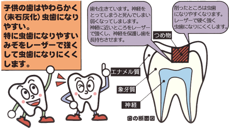 虫歯を治療します